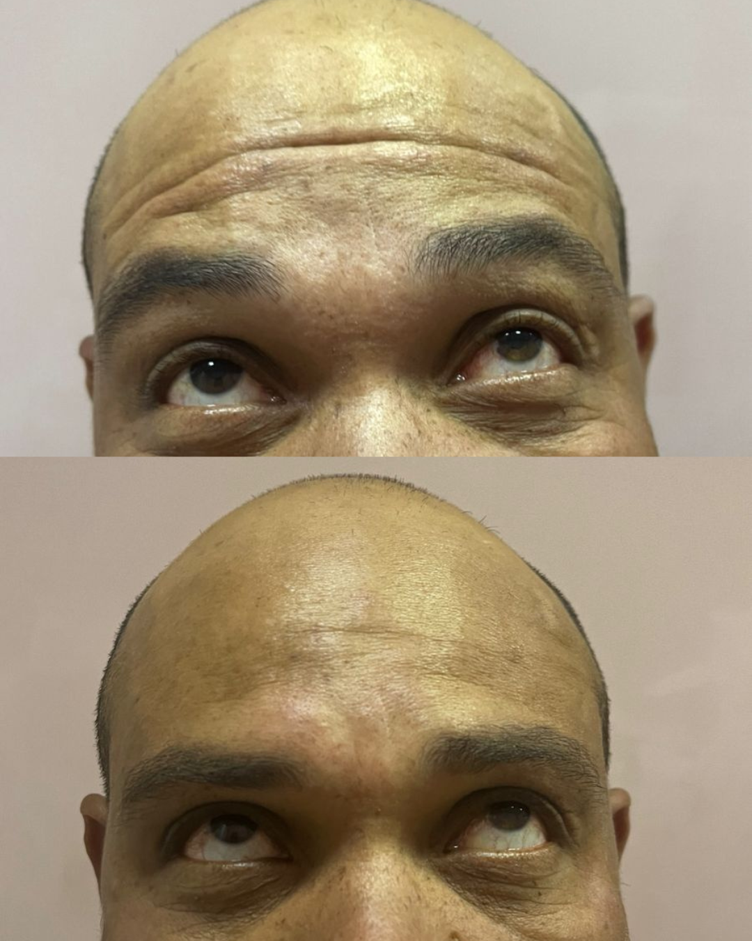 Tratamento de Rugas — resultado 1