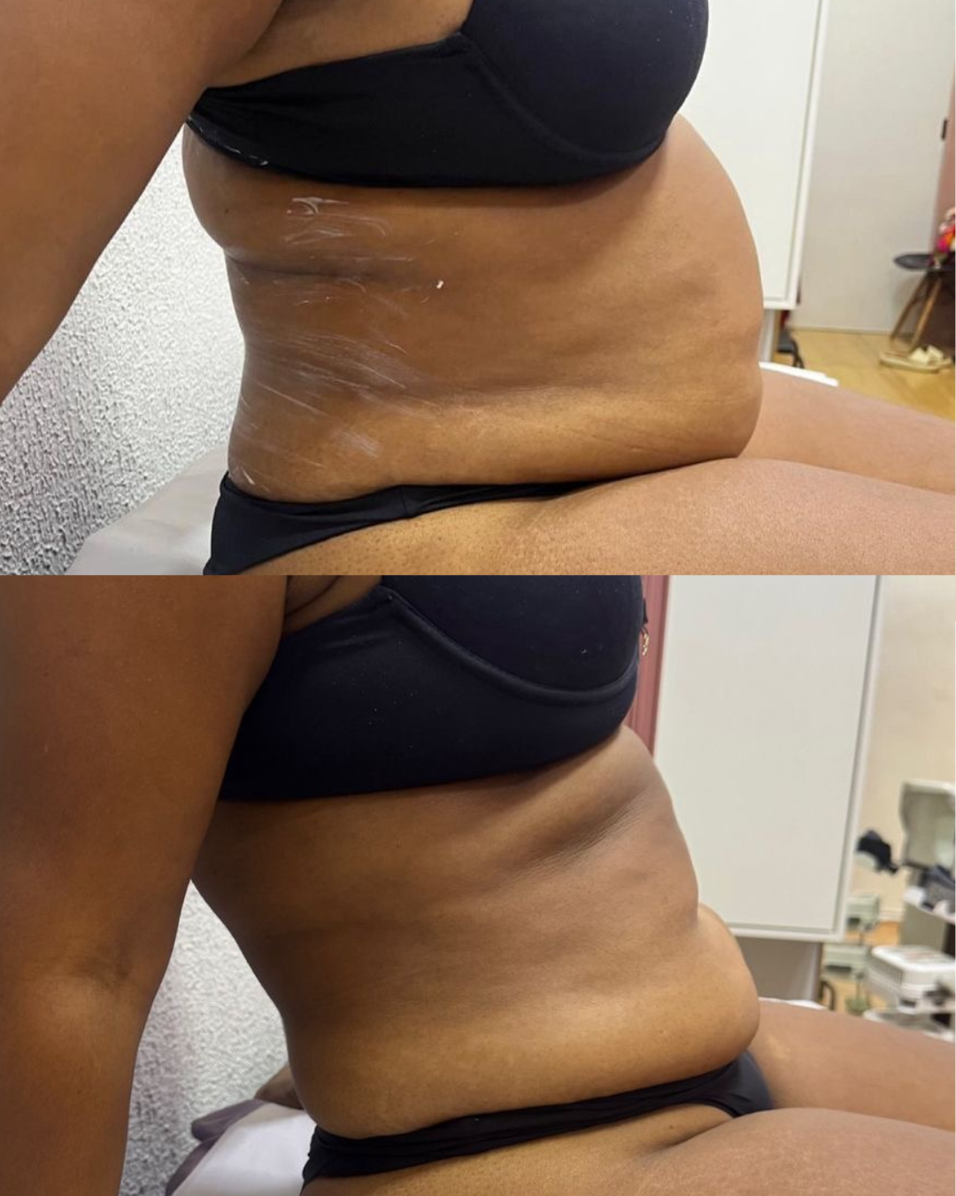 Resultado real LipoCrio — Criolipólise — paciente Emagreforma