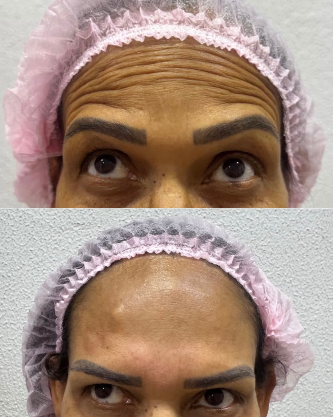 Tratamento de Rugas — resultado 3