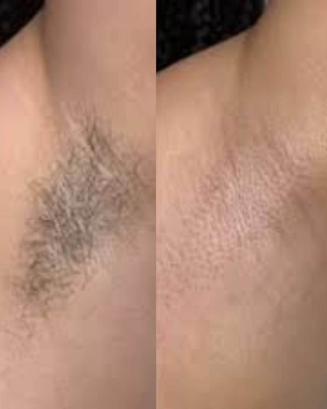 Resultado real Depilação a Laser — paciente Emagreforma