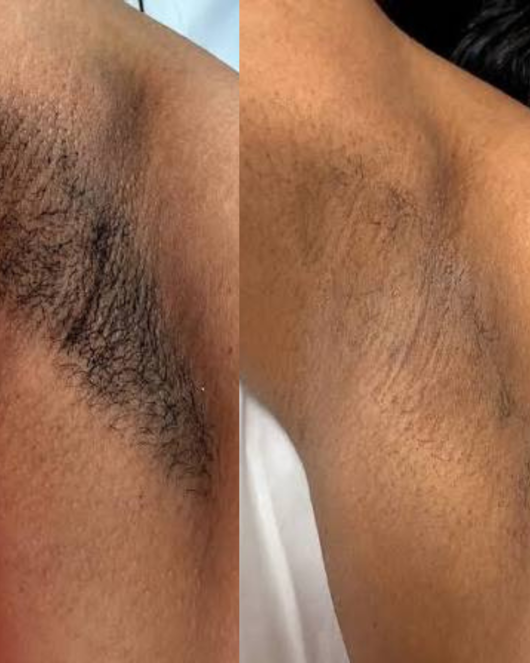 Depilação a Laser — resultado 2