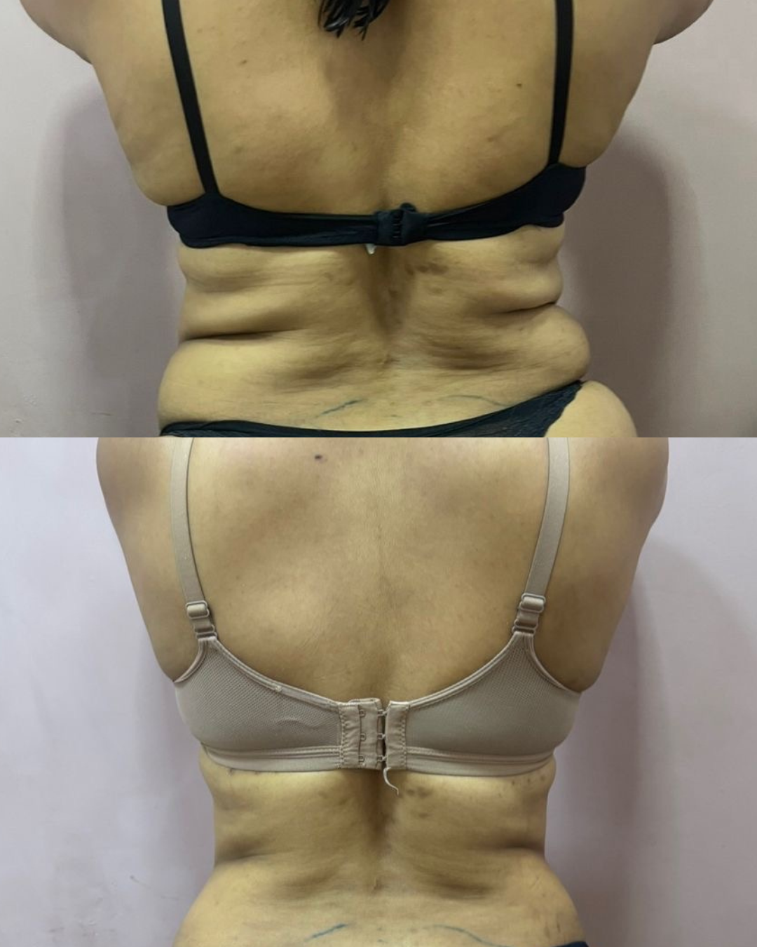 LipoCrio — resultado 3