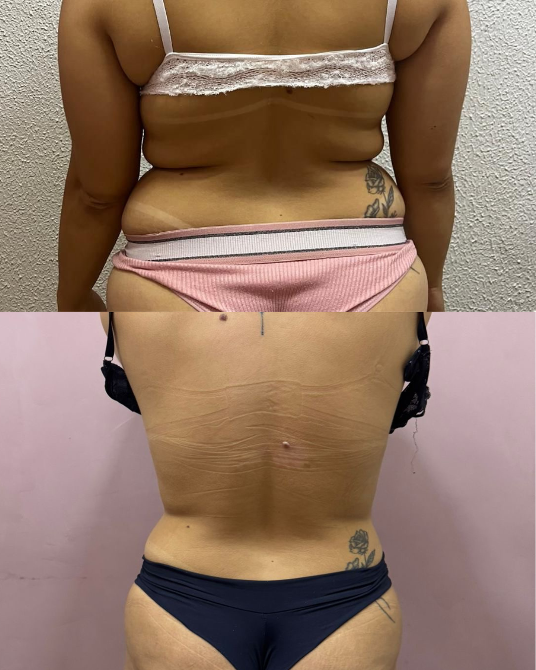 LipoCrio — resultado 2