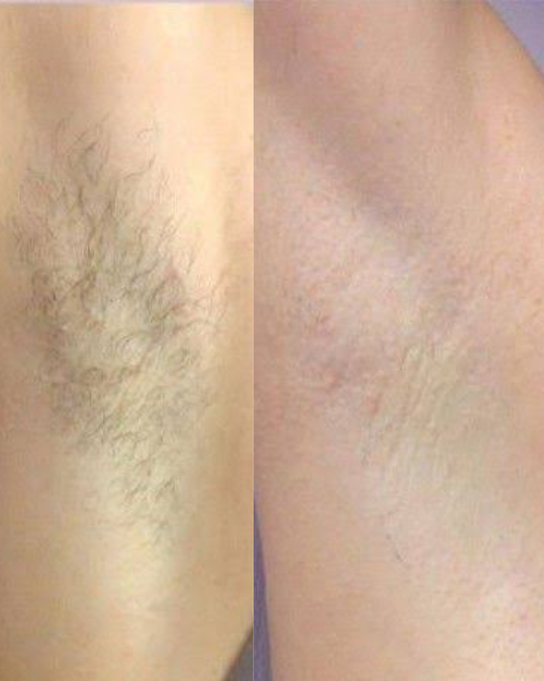 Depilação a Laser — resultado 3
