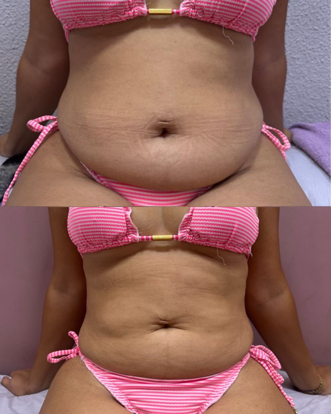 LipoCrio — resultado 4
